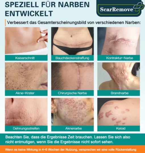 ScarRemove™ Fortgeschrittenes Narbenspray für alle Arten von Narben - Image 7