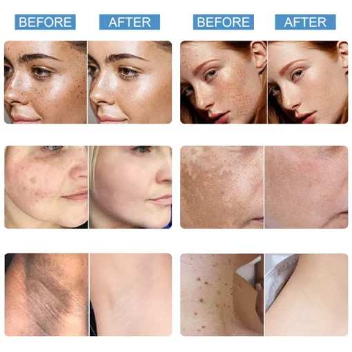 Fivfivgo™ Blemish Treatment Serum für dunkle Flecken & Acanthosis Nigricans & Skin Tag - Image 9