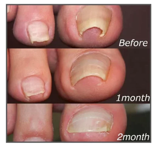 Nail Correction Patches - Image 3