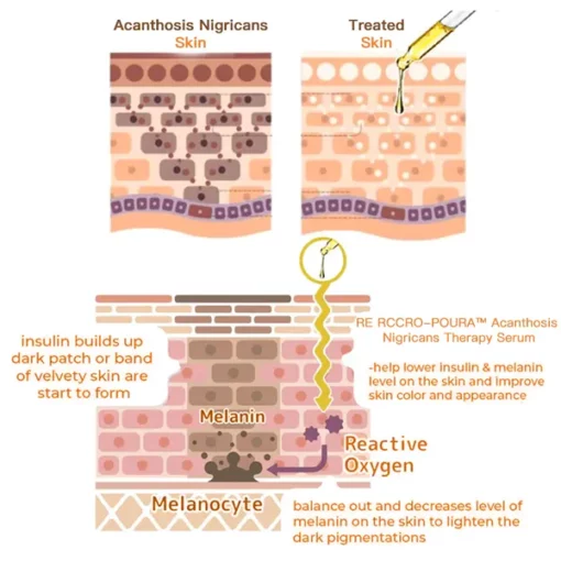 RE RCCRO-POURA™ Acanthosis Nigricans Therapy Serum - Image 3