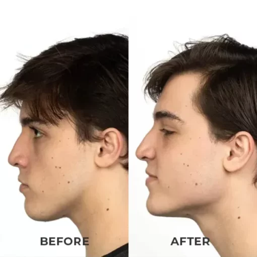 ShapeZ™ Jawline Exerciser - Image 5