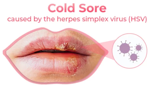 GFOUK™ Cold Sores Therapy Oil - Image 3