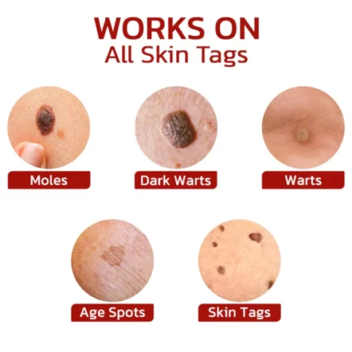 GFOEK™ Tags & Moles Remover - Image 4