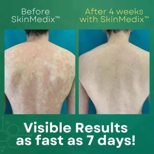 Universal Intense Psoriasis Skin Cream - Image 2