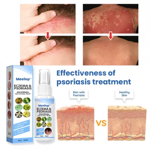 Suupillid™ Herbal Psoriasis Relief Spray - Image 3