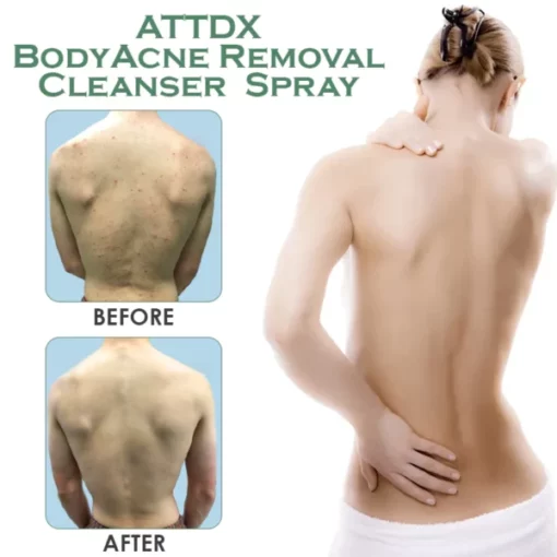 ATTDX BodyAcne Removal Cleanser Spray - Image 6