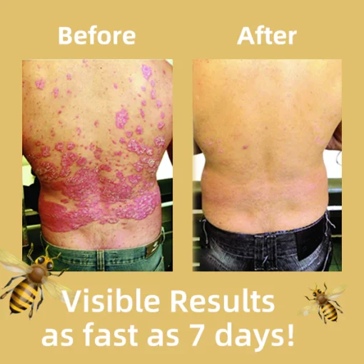 EdiJonah® Bee Venom Psoriasis Treatment Cream - Image 6