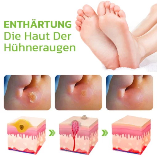 GFOUK™ IHerbal Fuß Schwielen und Hühneraugen Entfernung Soak - Image 8