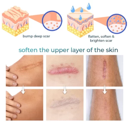 CNDB Bioskin™ Advanced Scar Removal Gel - Image 5