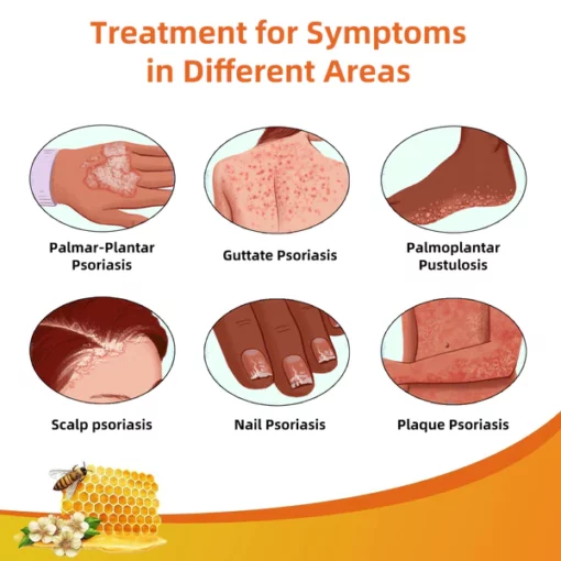 EdiJonah® Bee Venom Psoriasis Treatment Cream - Image 3