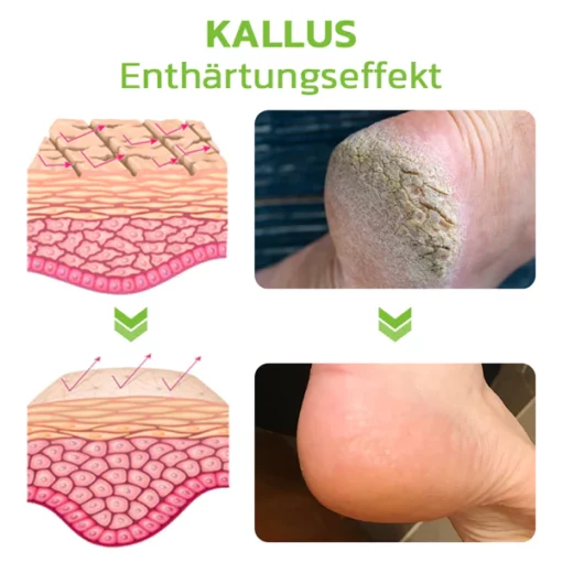 GFOUK™ IHerbal Fuß Schwielen und Hühneraugen Entfernung Soak - Image 4