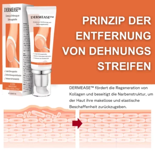 DERMEASE™ Creme zur Entfernung von Dehnungsstreifen