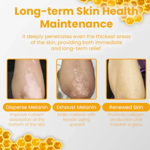 Oveallgo™ Vitiligo Rescue Bee Venom Care Cream - Image 6