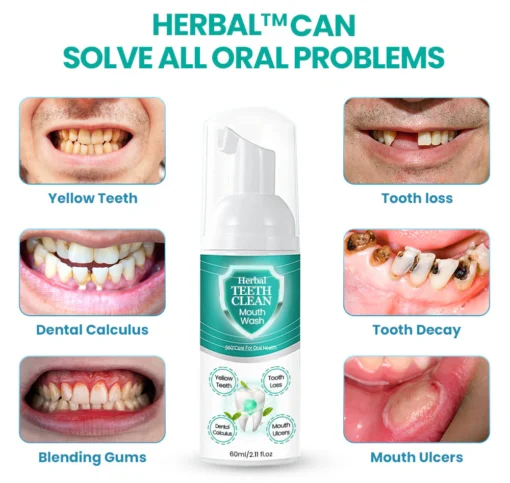 Herbal TEETHClean Mouthwash – Solve all Oral Problems