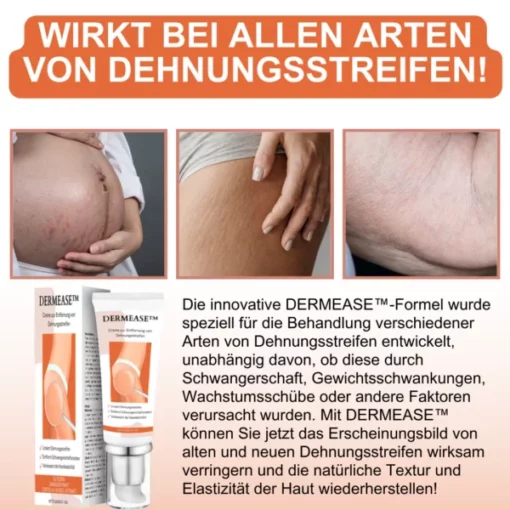 DERMEASE™ Creme zur Entfernung von Dehnungsstreifen - Image 6