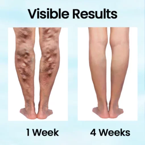 Ceoerty™ VeinMist Varicose Vein Spray - Image 4