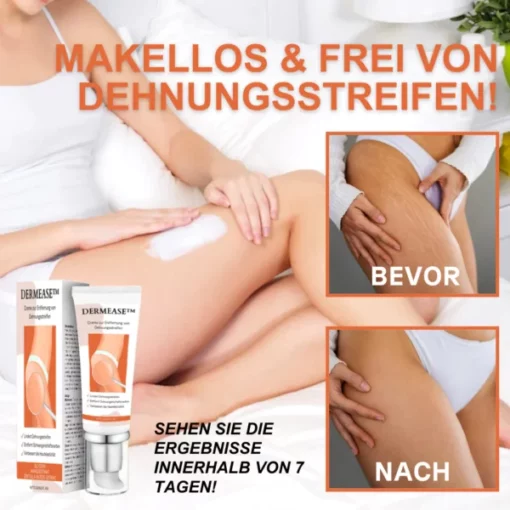 DERMEASE™ Creme zur Entfernung von Dehnungsstreifen - Image 3