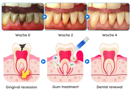 Furzero™ Haifischkollagen Zahnfleischpflege-Gel - Image 9