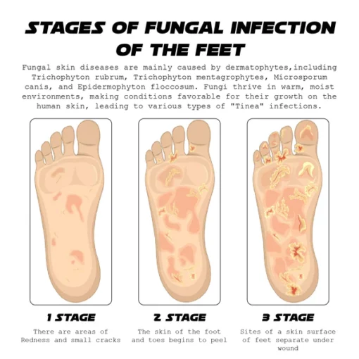 ATTDX AthletesFoot FungusRelief TreatmentSpray - Image 5