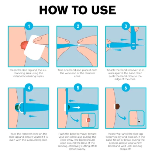 ATTDX AutoRemove SkinTag Kit - Image 7