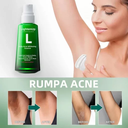 LightenUp™ Buttocks Acne Erasing Serum(for Acne & Spots & Acanthosis Nigricans Removal) - Image 4