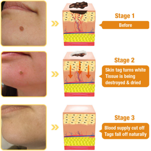 AQA™ Bee Venom Mole and Wart Treatment Cream - Image 7