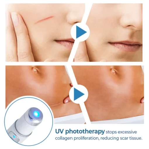 ScarFade™ UV Phototherapy Scar Removal Pen - Image 6