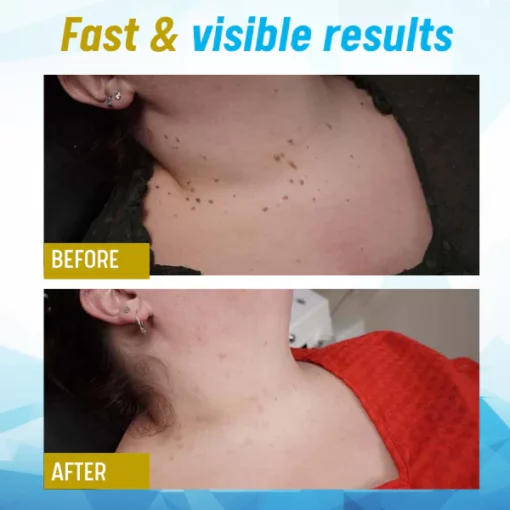 DermaZen™ Skin Tag Remover - Image 4