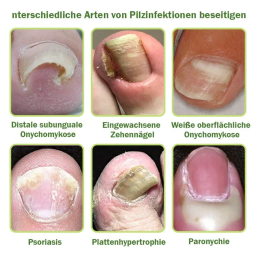 Furzero™ Nagelverteidigung Bienengift-Behandlungsserum - Image 7