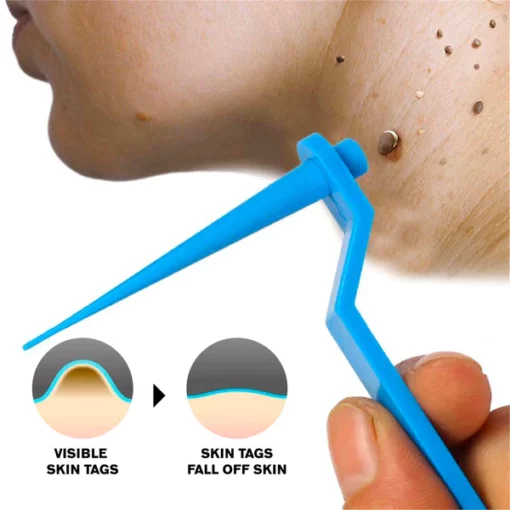 ATTDX AutoRemove SkinTag Kit - Image 4