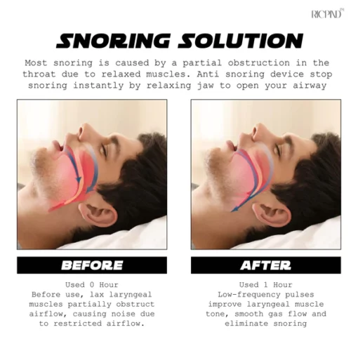 Ricpind AI Instant SnoringReduction Vibrating Stopper - Image 4