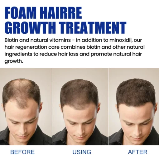 Renewhair X Hair Growth Foam - Image 4