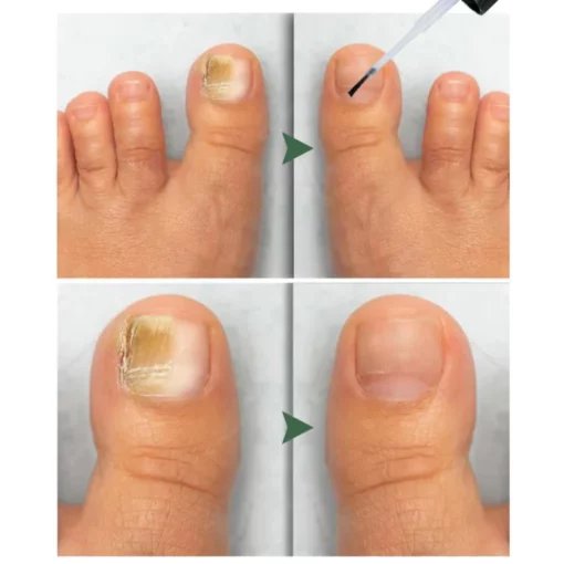 Furzero™ Herbal Formula Fungal Nail Treatment - Image 6