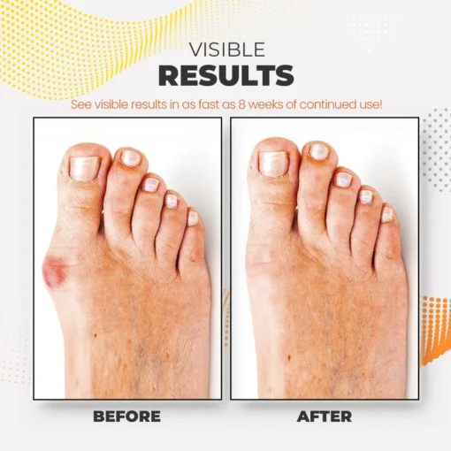 Bunion Relief Fit Patch - Image 11