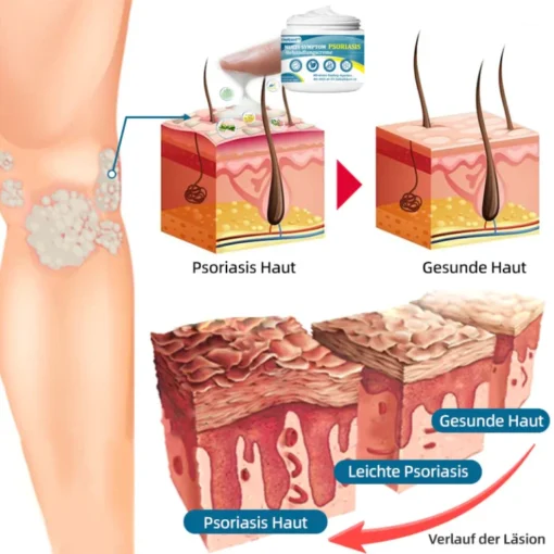 Ourlyard™ Multi-Symptom Psoriasis-Behandlungscreme - Image 7