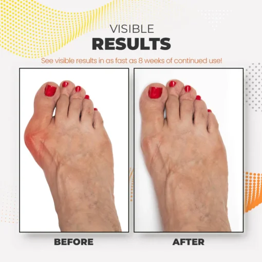 Bunion Relief Fit Patch - Image 6